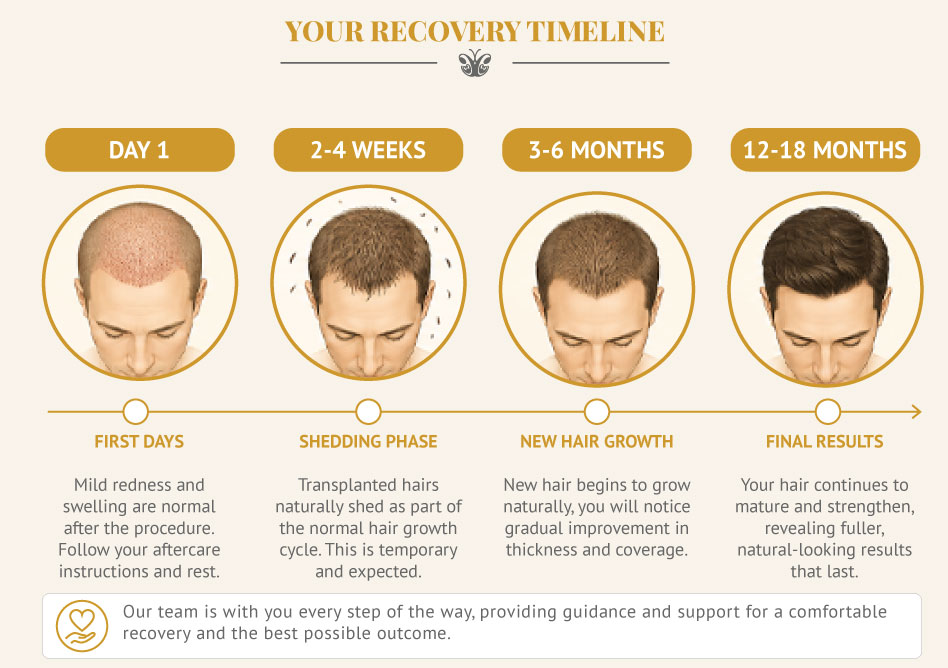 Illustration Fue Hair transplant recovery timeline