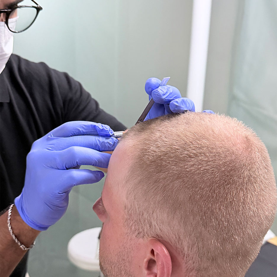 Doctor mapping out for hair transplant.